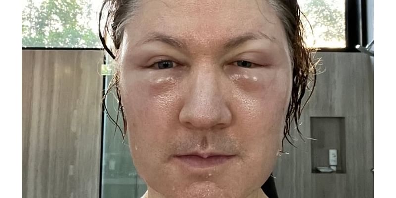 Anti-ageing 'guru' Bryan Johnson shares shocking selfie showing how his latest attempt to turn back the clock went disastrously wrong