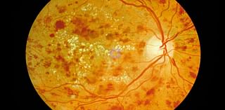 Preventing blindness caused by diabetes