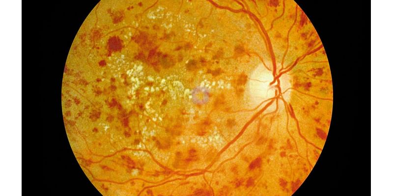 Preventing blindness caused by diabetes