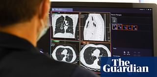 ‘Amazing’ trial shows drug combination stops lung cancer advancing for longer