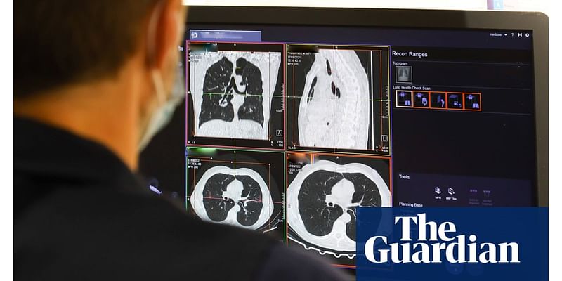 ‘Amazing’ trial shows drug combination stops lung cancer advancing for longer