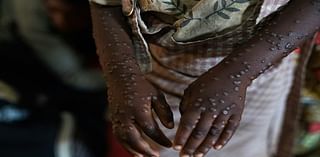 Third of Burundi mpox cases in children under five: UN