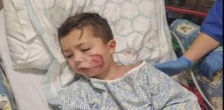 Vicious XL Bully attack leaves five-year-old boy with life-changing injuries and needing facial reconstruction surgery