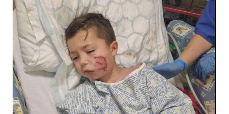 Vicious XL Bully attack leaves five-year-old boy with life-changing injuries and needing facial reconstruction surgery