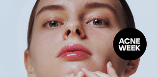 Acne Face Map: Here's Why You're Breaking Out, According to Derms