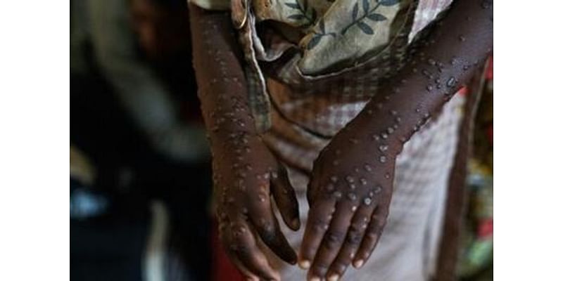 Third of Burundi mpox cases in children under five: UN