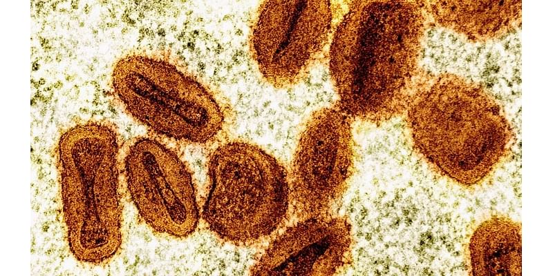 US health officials report 1st case of new form of mpox in a traveler