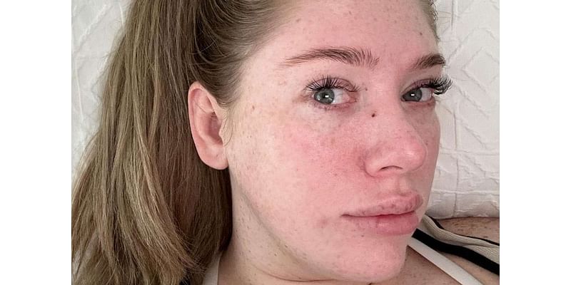 'Blocked Pore' Turns Out to Be Skin Cancer for 29-Year-Old Mom: 'I Had Such a Bad Feeling About It'