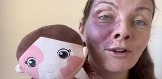 Aldi praised for new inclusive toy range which features dolls with cochlear ear implants and vitiligo