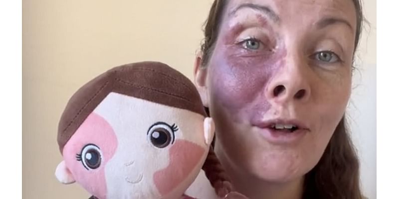 Aldi praised for new inclusive toy range which features dolls with cochlear ear implants and vitiligo