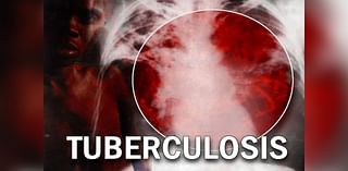 Arkansas seeing record-setting tuberculosis case numbers