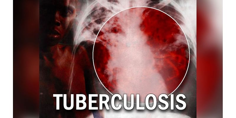 Arkansas seeing record-setting tuberculosis case numbers