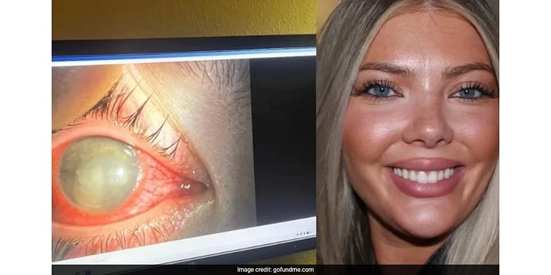 US Woman, 23, Goes Blind In One Eye After Swimming With Contact Lenses: "Most Pain I've Ever Experienced"