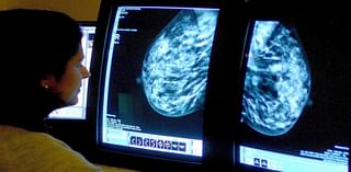 Low take-up of breast screening ‘led to 30,000 missed cancer diagnoses’