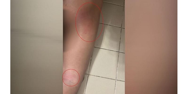 Mom claims school staff member hog-tied son, left bruises on him